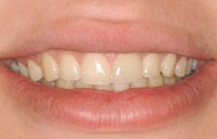 chipped_after_textmedium