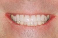 rj_afterfrntlips5in_textmedium