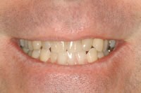 rj_beforefrntlips5in